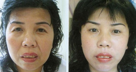 鼻唇溝除皺——鄭女士