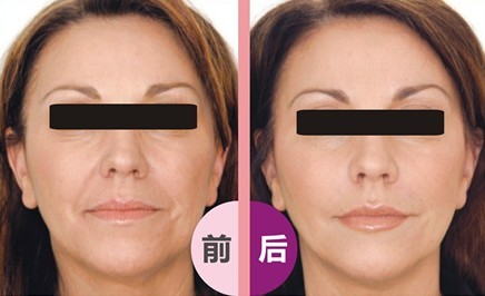 法令紋除皺——令女士