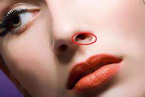 縮鼻孔-林賢超醫(yī)生