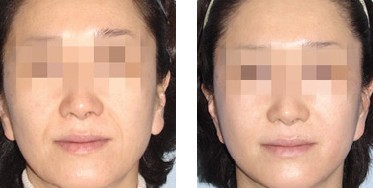 玻尿酸注射除皺——杜女士