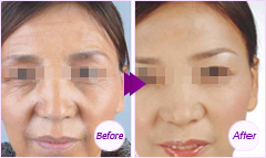 脂肪干細胞面部種植——劉女士