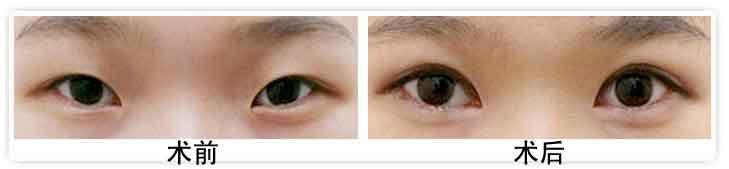 開(kāi)眼角術(shù)后.jpg