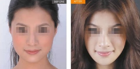 下頜角整形——安小姐