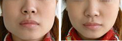 微動(dòng)力微孔改臉型——鄭小姐