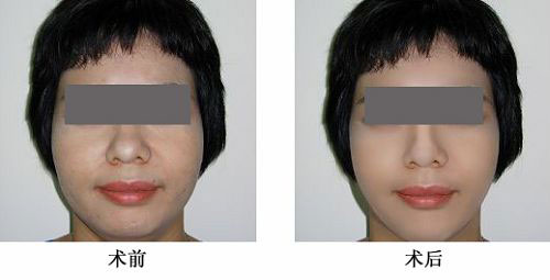 光子嫩膚——楊小姐