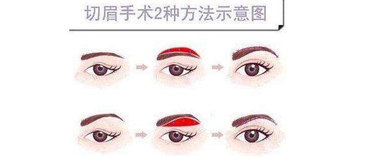 切眉術(shù).jpg