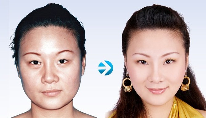 電波拉皮除皺——姚女士