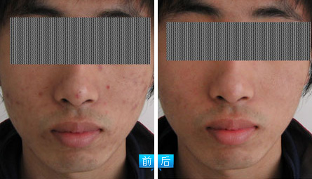 飛頓像素激光之祛除痘印——秦先生