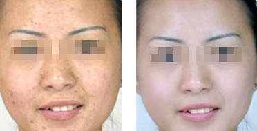 復(fù)合彩光祛痘——由小姐