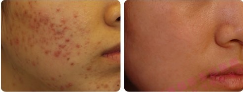 激光祛痘——田小姐