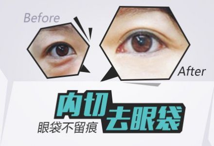 內切祛眼袋.jpg