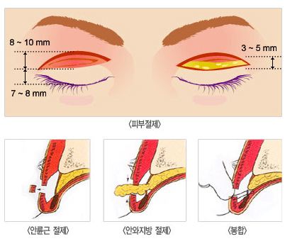 雙眼皮術.jpg