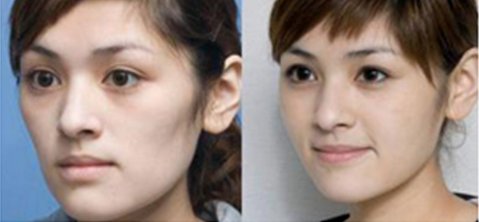 面部填充——鄭小姐