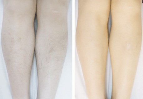 小腿冰點脫毛——莊小姐