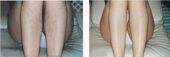 小腿冰點脫毛——王小姐