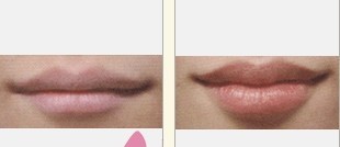 玻尿酸豐唇——李女士