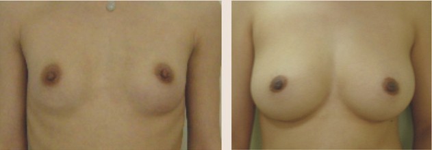 麥格假體隆胸——?jiǎng)⑴? /></a></div>
                        <span><h1><a href=