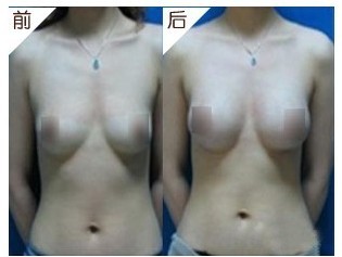 水滴形假體隆胸——?jiǎng)⑿〗? /></a></div>
                        <span><h1><a href=