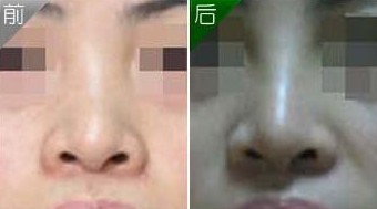 隆鼻手術(shù)失敗修復(fù)——?jiǎng)⑿〗? /></a></div>
                        <span><h1><a href=