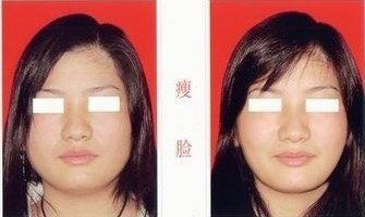 吸脂瘦臉——張小姐