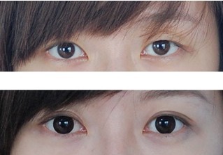 開眼角手術(shù)——鄭小姐