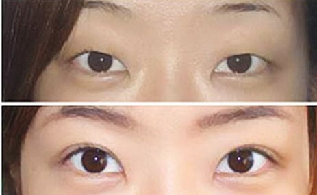 雙眼皮手術(shù)成功案例——田小姐