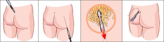 臀部吸脂